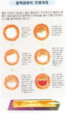 내부의 적 지방간,콜레스테롤 1